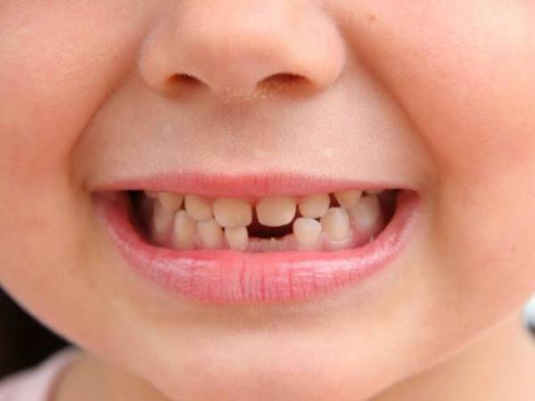 Ý nghĩa chung của giấc mơ thấy rụng răng là điềm gì?
