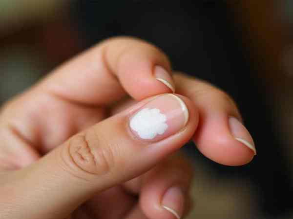 Đốm trắng trên móng tay Đốm trắng trên móng tay